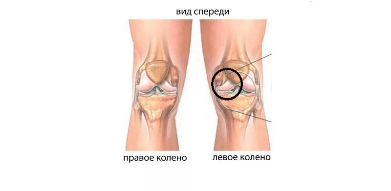 Боль под коленом спереди. Боль в колене сбоку с внутренней стороны. Болит колено сбоку с внутренней стороны. Болит колено внутри сбоку с внутренней стороны. Болит около колена с внутренней стороны сбоку.