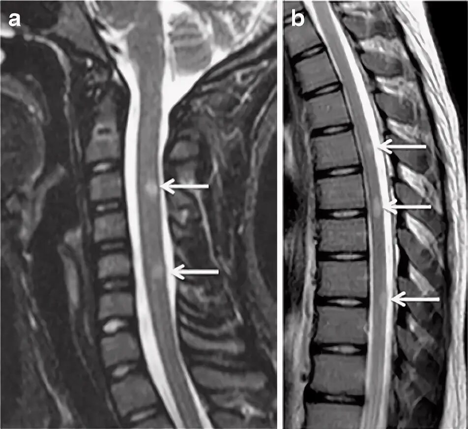 Рассеянный склероз шейного отдела. Рассеянный склероз на мрт позвоночника. Рассеянный склероз шейного отдела мрт. Мрт рассеянный склероз спинной мозг. Демиелинизация спинного мозга мрт.