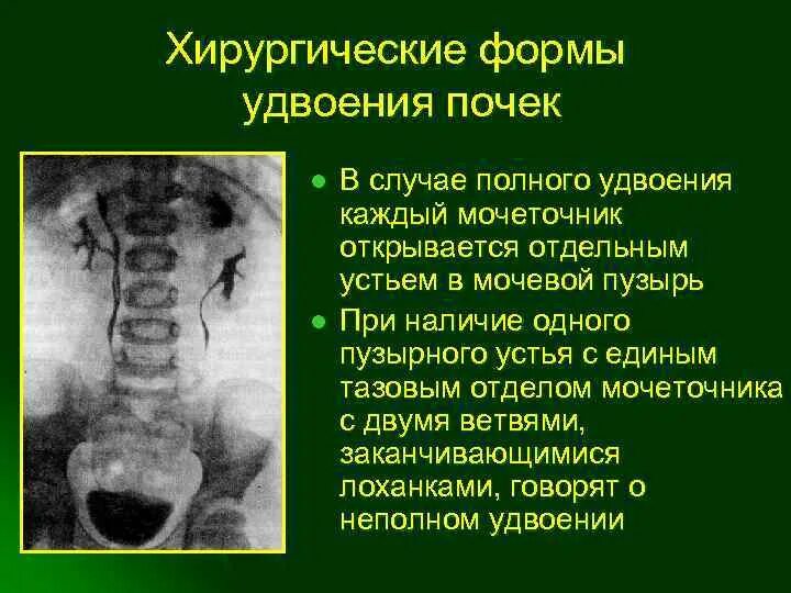 Удвоение мочеточника. Гидронефроз урография рентген. Удвоение почки экскреторная урография. Врожденное удвоение почки. Удвоение лоханки и мочеточника.