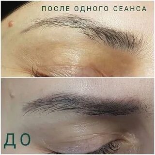 Удаление ремувером отзывы