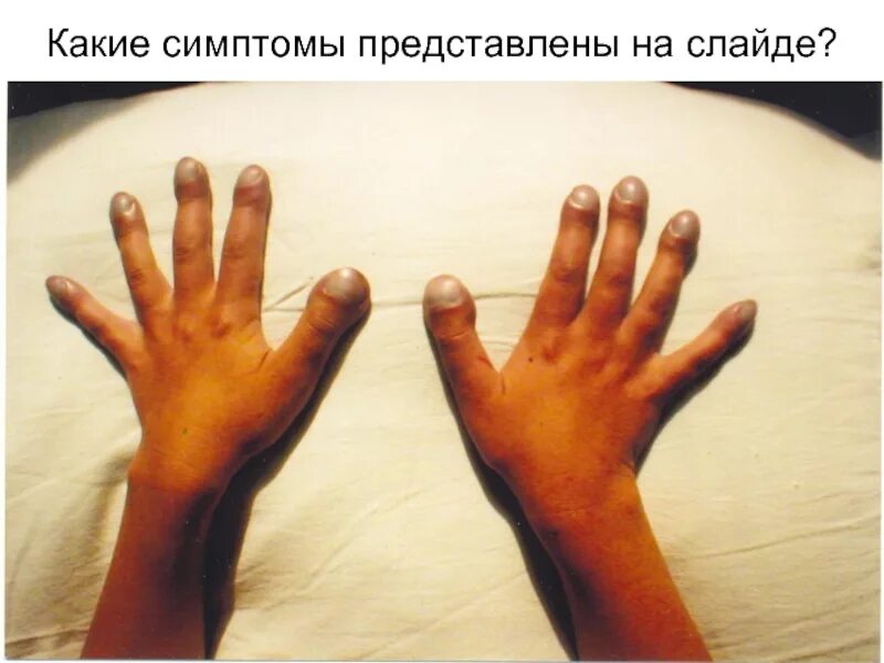 Симптом часовых. Пальцы барабанные палочки муковисцидоз у детей. пальцы в виде барабанных палочек у детей. симптом барабанных палочек у детей. синдром барабанных пальцев у детей.