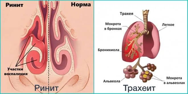 Отек при трахеите. Отек при трахеите