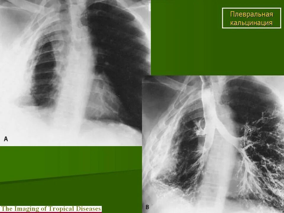 Шварты в легких это. Плащевидное обызвествление плевры. Обызвествление плевры на кт. Кальциноз плевры рентген.