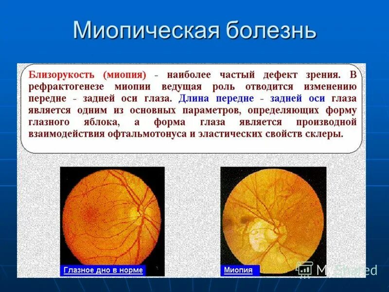 Глазное дно при миопии миопический конус стафилома.