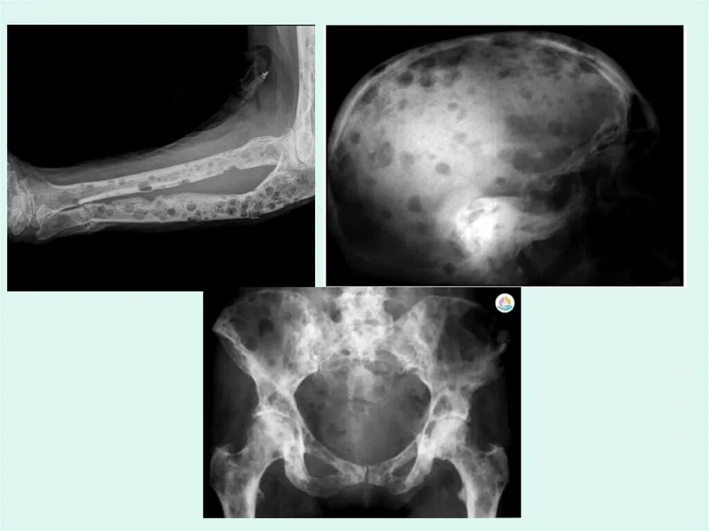 Миеломная болезнь рентген черепа. Кости черепа при миеломной болезни. Множественная миелома рентген черепа. Рентген черепа при миеломной болезни.