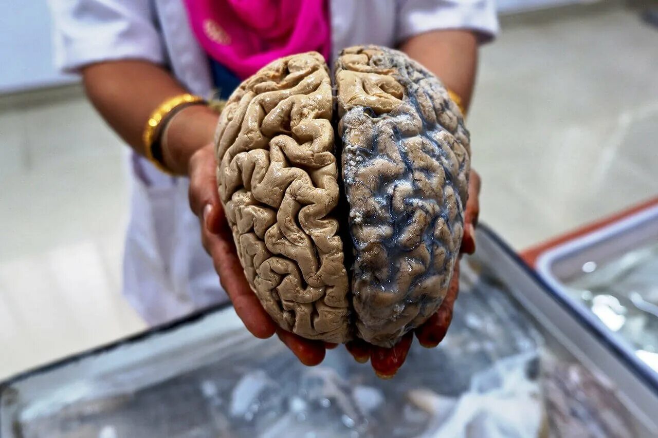 Головной мозг живой. Натовщий мозг человека. Настоящий человеческий мозг.