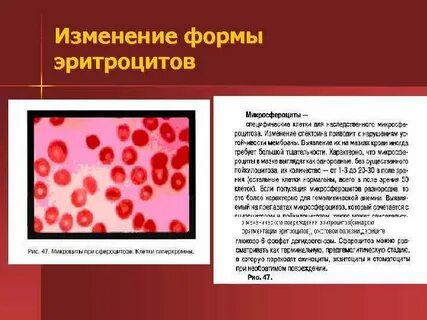 Изменение формы эритроцитов