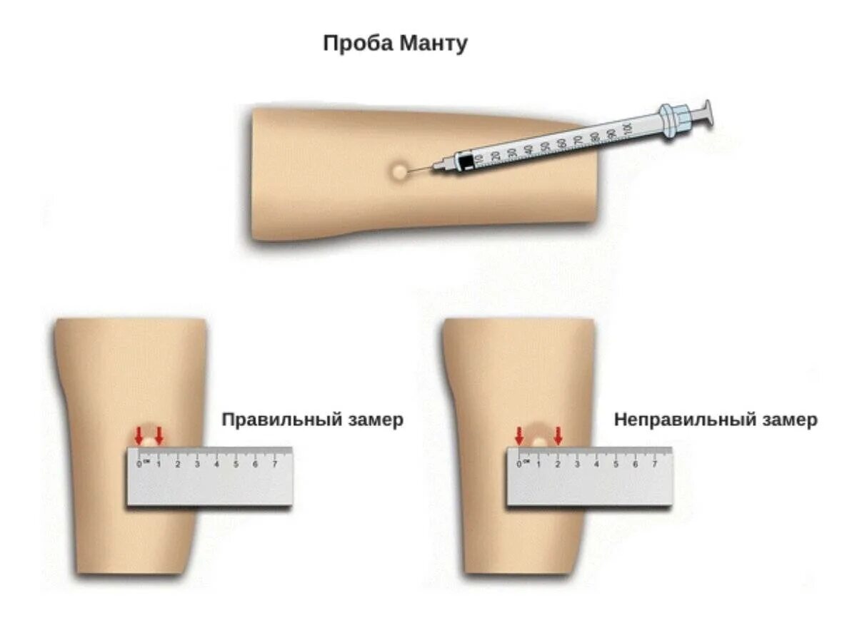 После прививки ставить манту. Папула 4 мм реакция манту. Туберкулинодиагностика реакция манту. Реакция манту папула 5 мм. Туберкулиновая проба манту норма.