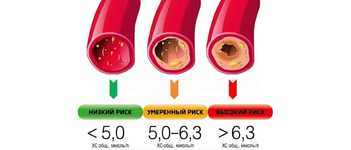 Уровень холестерина. Priznaki visokova xolesterina. Симптомы высокого холестерина. Симптомы высокого холестерина в крови.