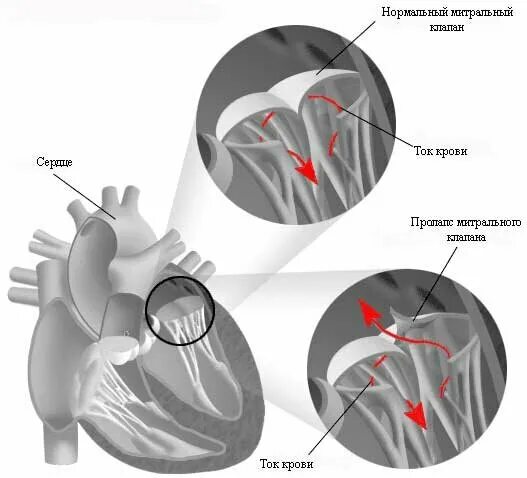 Пмк в кардиологии. Пмк в кардиологии. Пролапс митрального клапана симптомы у детей. Параллакс митрального клапана 1 степени. Что такое пролапс митрального клапана сердца 1 степени.