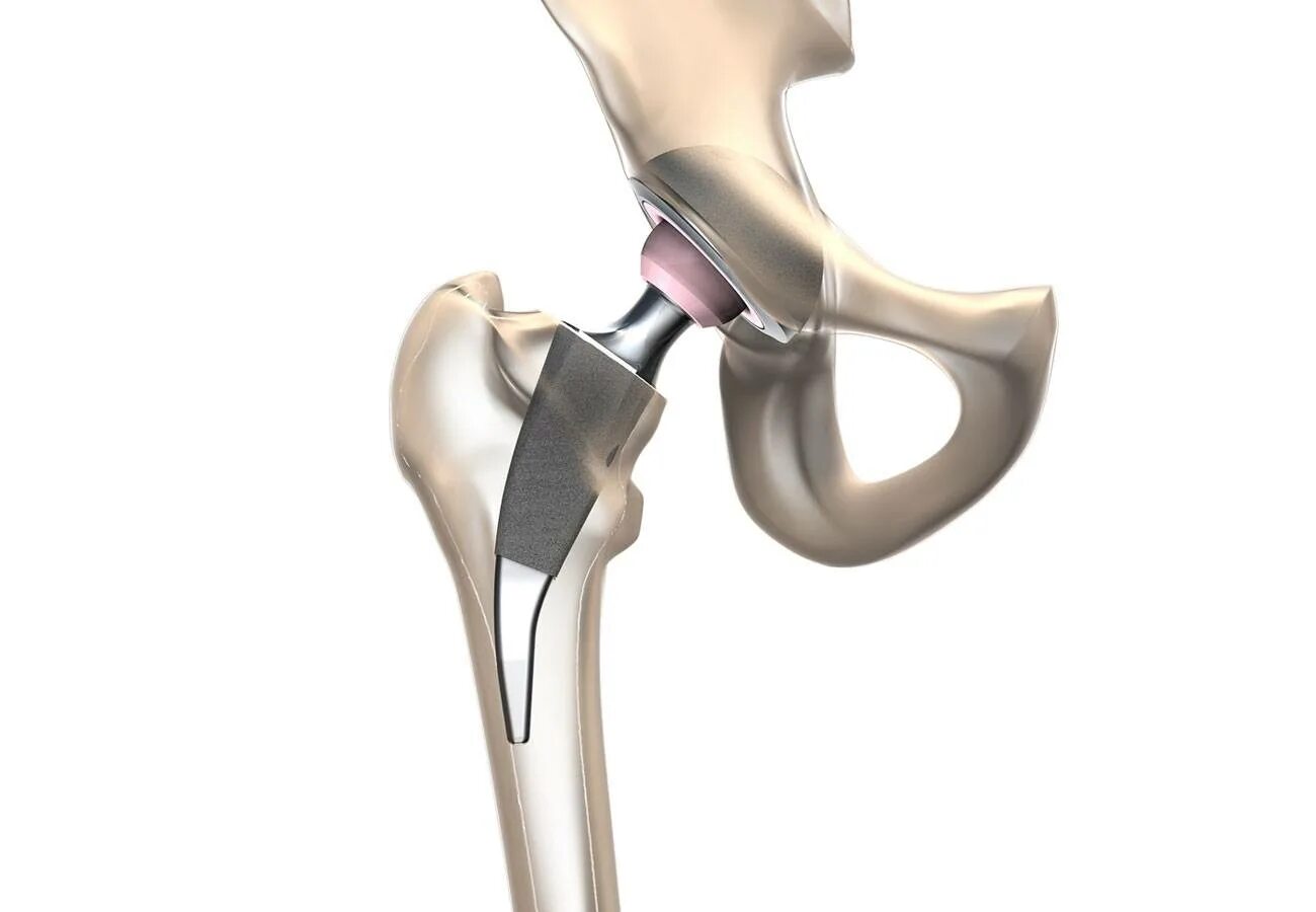 Замена сустава шейки бедра. Эндопротез Зиммер тазобедренного сустава. Тазобедренный эндопротез Stryker. Smith nephew эндопротез тазобедренного сустава. Эндопротез коленного сустава Stryker.