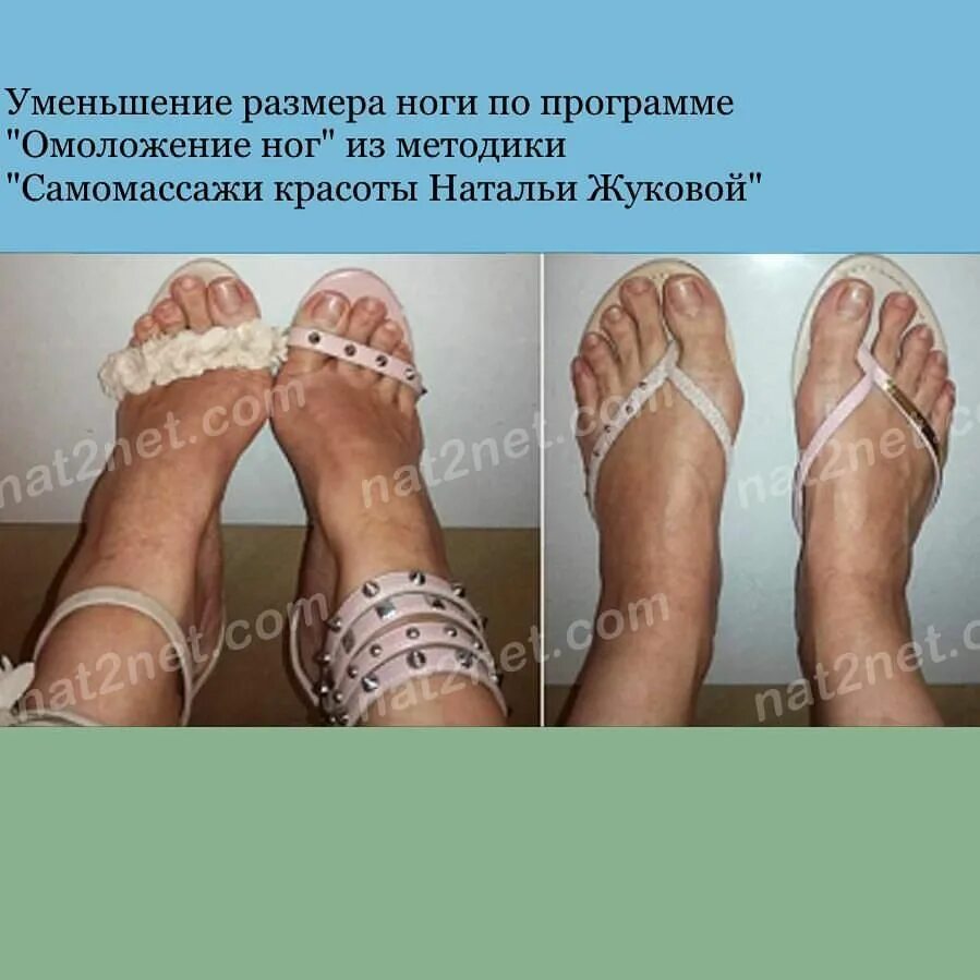 Как уменьшить размер обуви на размер. Хирургическое уменьшение стопы. операция по уменьшению ширины стопы. как уменьшить стопу.