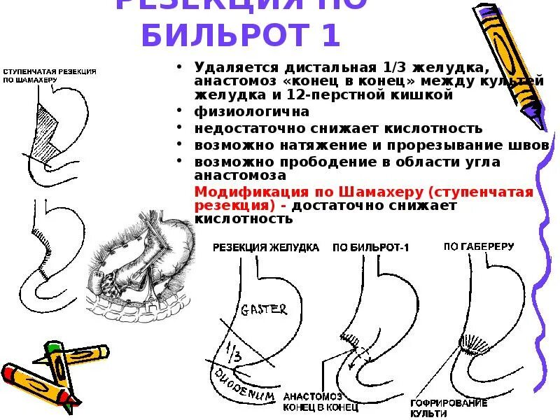 Операции на желудке Бильрот 2. Операция на желудке Бильрот 1. Операция желудка кишечника