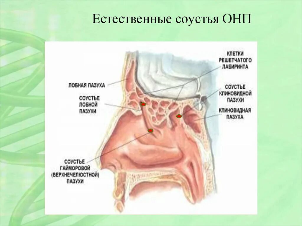 Соустья верхнечелюстных пазух. Соустья гайморовых пазух. Соустье гайморовой пазухи с носом. Пазухи носовой полости анатомия. Утолщение слизистой оболочки решетчатых лабиринтов