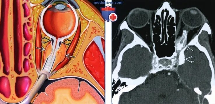 Периневральное пространство зрительного нерва. Менингиома зрительного нерва кт. Менингиома зрительного нерва мрт. Расширение периневральных пространств зрительных нервов мрт. Расширение оболочек зрительных нервов.