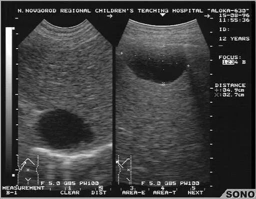 анэхогенное образование неровные контуры
