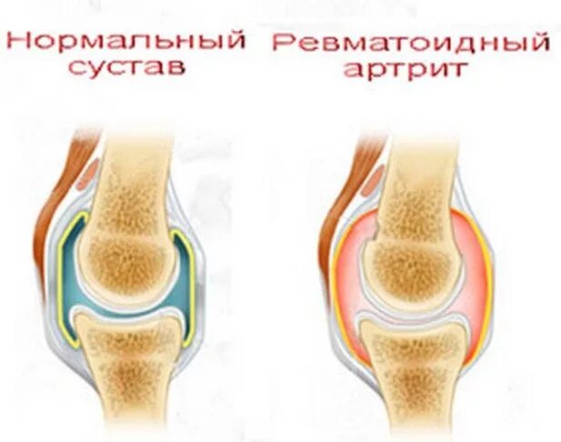 Ревматоидный артрит суставы. Ревматоидный артрит коленного сустава рисунок. Суставная форма ревматоидного артрита. Ревматоидный артрит мышцы