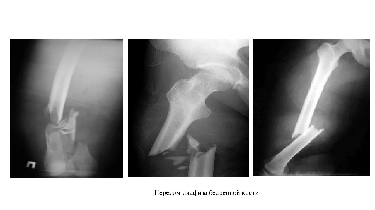 Сколько заживает бедро. Перелом с/3 диафиза бедренной кости. Оскольчатый перелом диафиза плечевой кости. Перелом нижней трети диафиза правой бедренной кости. Перелом средней трети диафиза бедра.