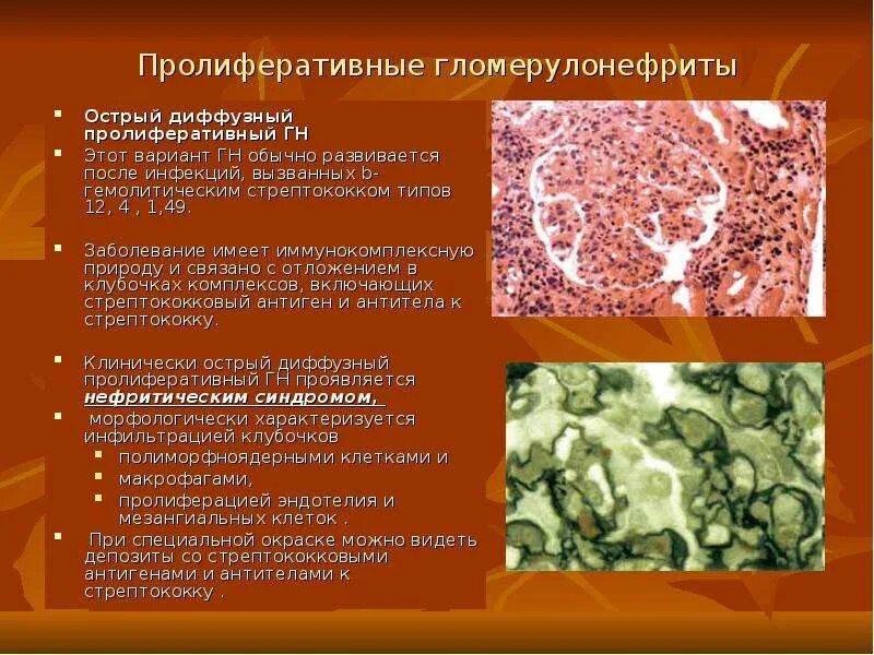 Остром диффузном гломерулонефрите