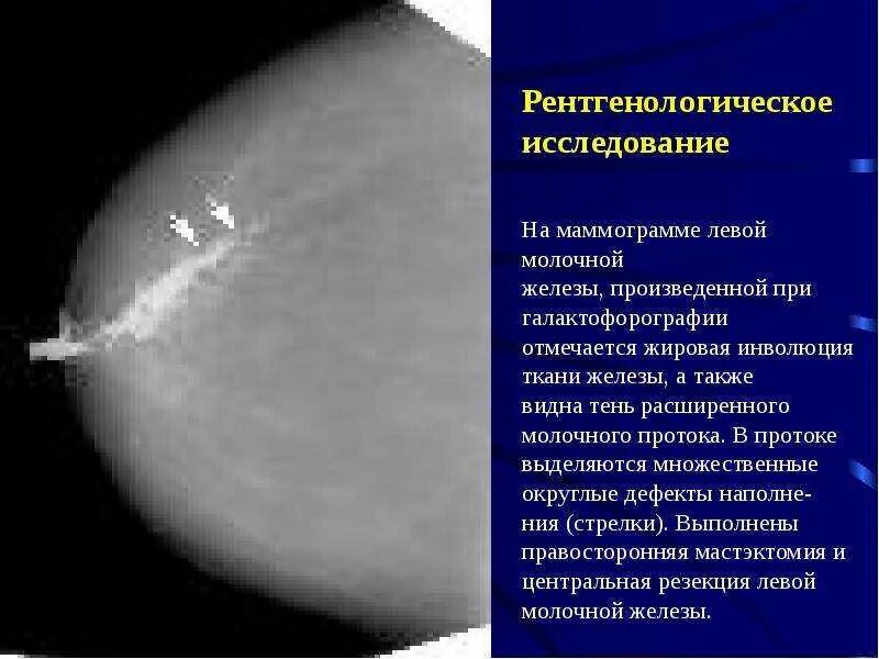 Признаки фиброзных изменений молочных. Расширение млечных протоков молочной железы. Фиброзно-жировая инволюция молочных желез на УЗИ. Молочные железы жировая инволюция УЗИ. Фиброаденоз маммография.