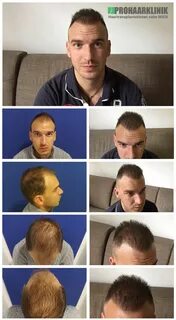 Сколько после пересадки волос