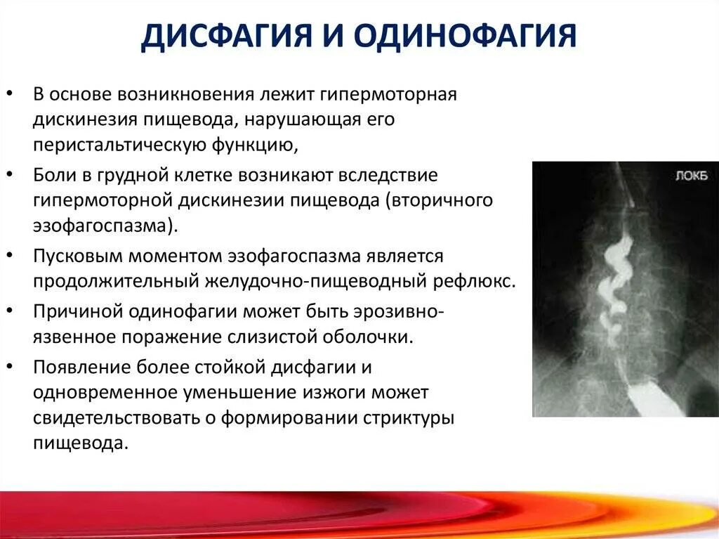 Ком в пищеводе причины. Дисфагия и одинофагия. Гипермоторная дискинезия пищевода. Нарушение глотания симптомы.