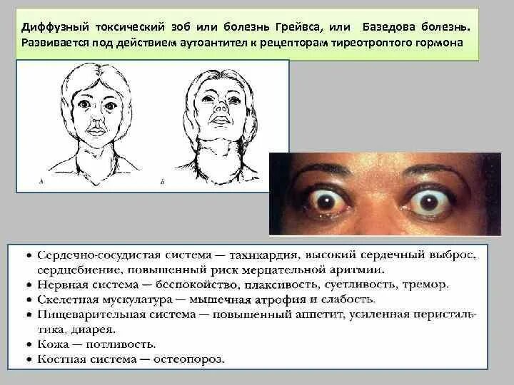 Диффузный зоб диагностика. Диффузный токсический зоб (базедова болезнь). Щитовидная железа при болезни Грейвса. Токсический зоб экзофтальм. Диффузный токсический зоб (болезнь Грейвса).