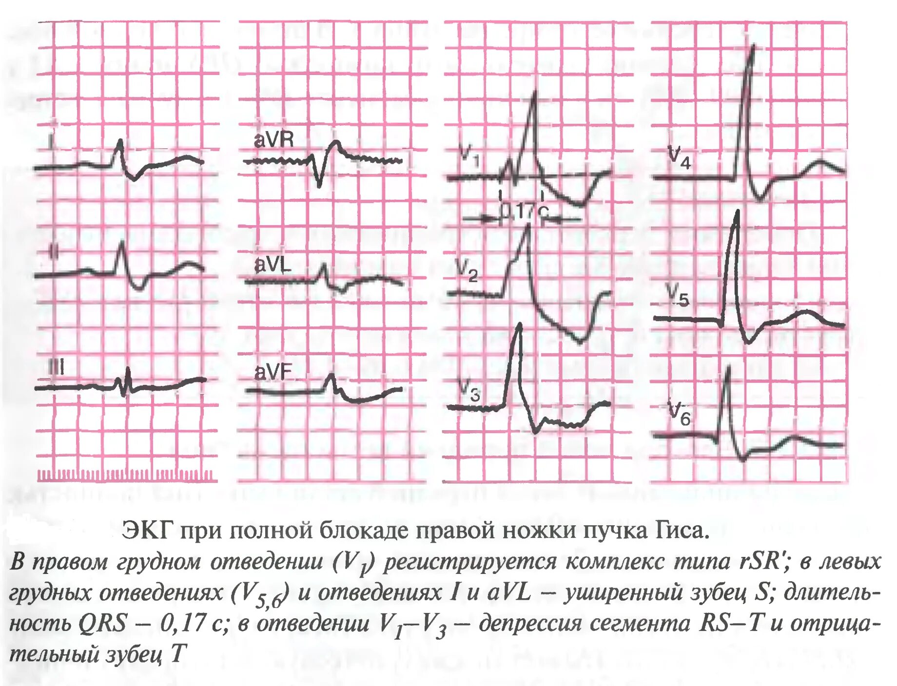 Блокада qrs. Блокада правой ножки пучка Гиса на ЭКГ. Полная и неполная блокада правой ножки пучка Гиса. Кардиограмма сердца блокада правой ножки пучка Гиса. М образный зубец r на ЭКГ.