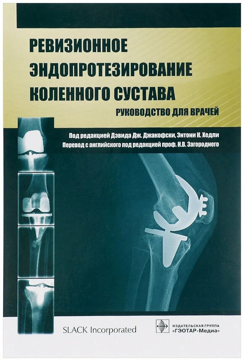 онкологический эндопротез коленного сустава. ревизионное эндопротезирование тазобедренного. ревизионный коленный эндопротез. ревизионные эндопротезы. эндопротез коленного сустава stryker.