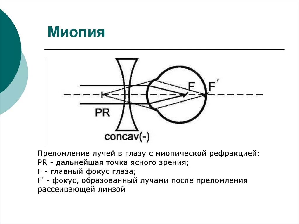 Миопия дальнейшей точкой ясного зрения. Миопия схема глаза. Рефракция миопия. Миопия схема преломления лучей. Миопия что это простыми словами