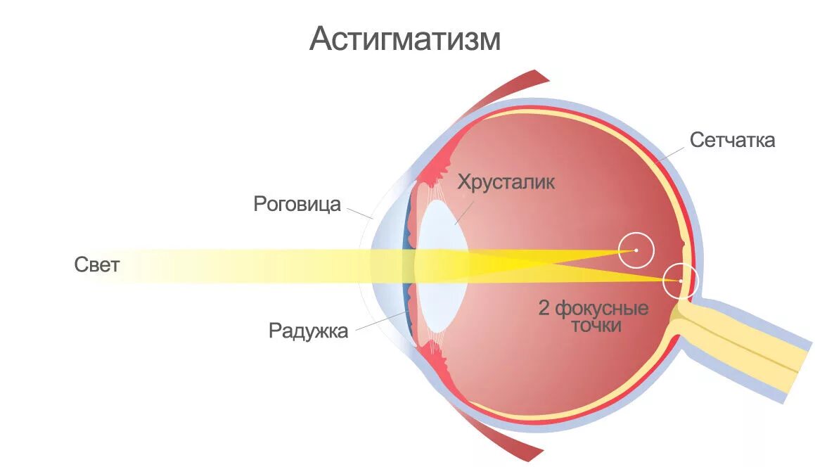 Слабая миопия глаза что. Миопический астигматизм слабой степени. Астигматизм сложный миопический слабой степени ou. Астигматизм -3.5. Астигматизм схема.