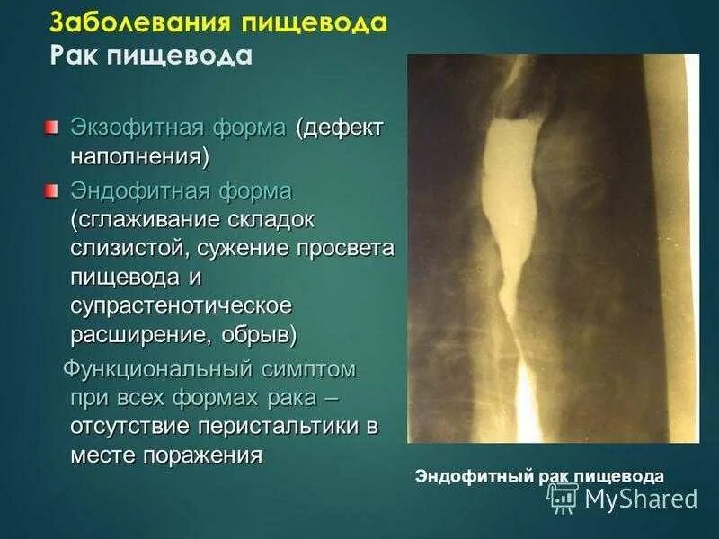 Признаки пищевода. Опухоль пищевода рентген. Стриктура пищевода рентген симптомы. Опухоль средней трети пищевода. Симптомы поражения пищевода.