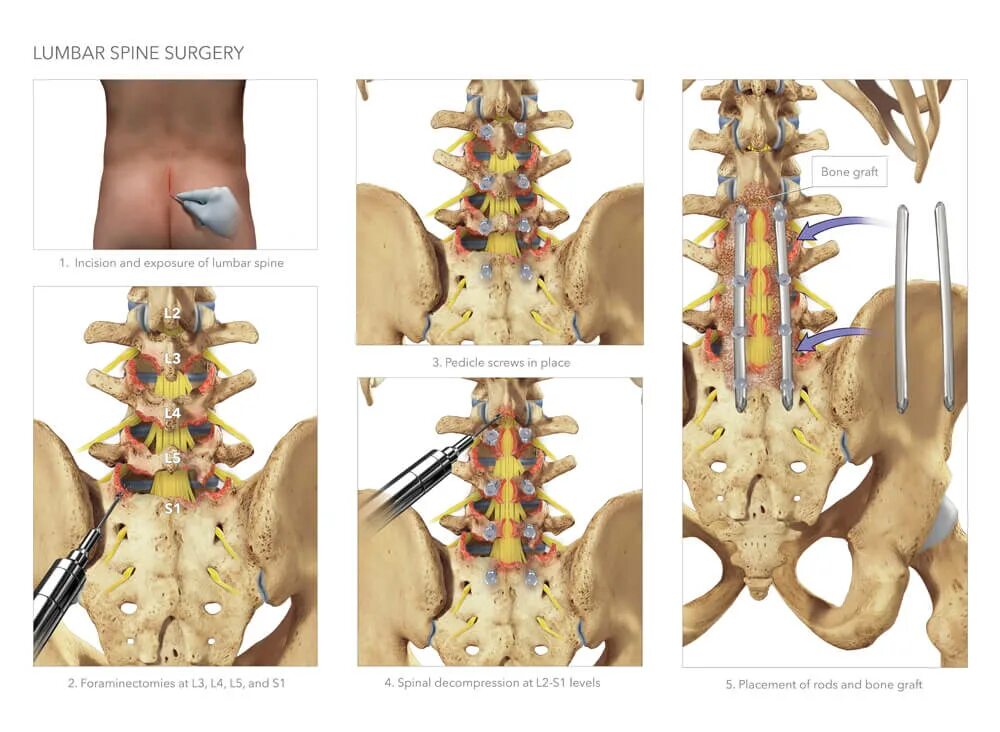 Ламинэктомия позвоночника l5s1. Декомпрессия Корешков позвоночника. Декомпрессионная ламинэктомия l1 позвонка. Транспедикулярная фиксация позвоночника l5-s1. Конструкция позвоночника операция