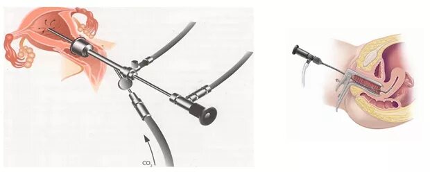 Гистероскопия раздельное выскабливание. Гистероскопия матки гистерорезектоскопия. Гистерорезектоскопия миомы матки. Гистерорезектоскопия полипа эндометрия. Гистероскопия с биопсией эндометрия.