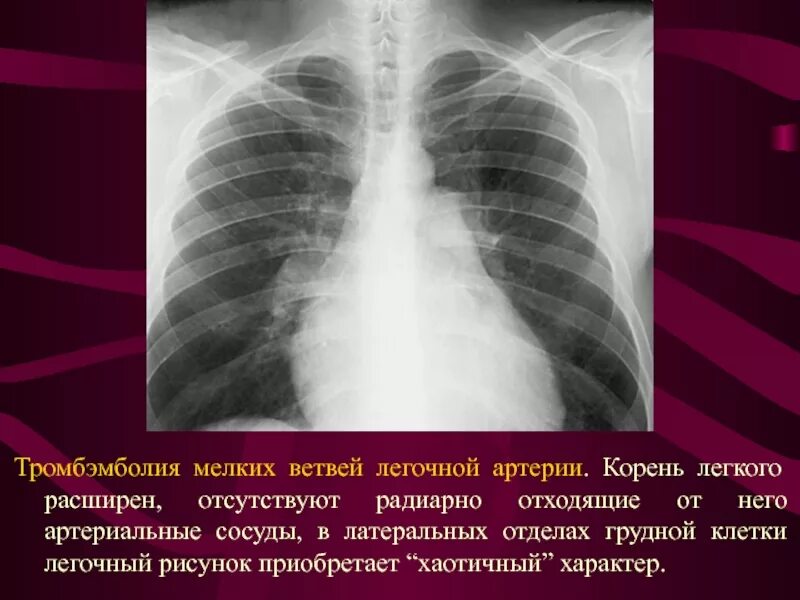 Увеличение корень легкого. Тромбоэмболия мелких ветвей легочной артерии рентген. Тэла симптомы рентгенодиагностика. Расширение легочной артерии рентген. Аневризма легочной артерии рентген.