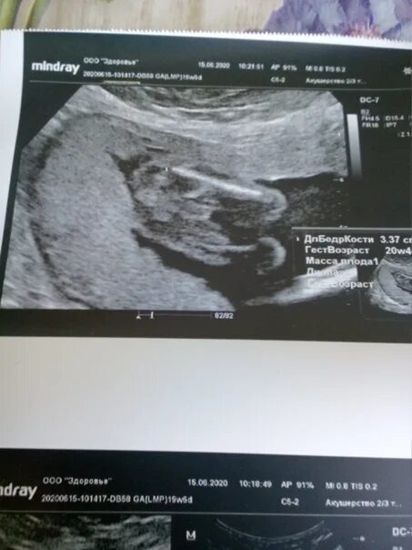 Пол ребенка на узи. Мальчик и девочка на узи. Узи пол ребенка заключение. Девочка на узи. На узи мальчик родилась девочка.