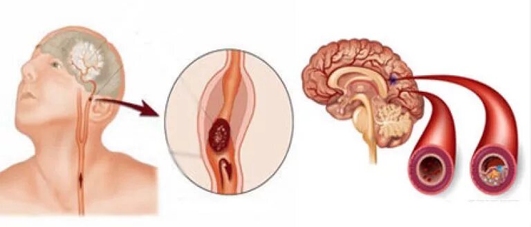 Закупорка головных сосудов. Атеросклеротическое поражение сосудов головного мозга. Атеросклероз головного мозга симптомы. Атеросклероз артерий головного мозга. Атеросклероз церебральных сосудов.
