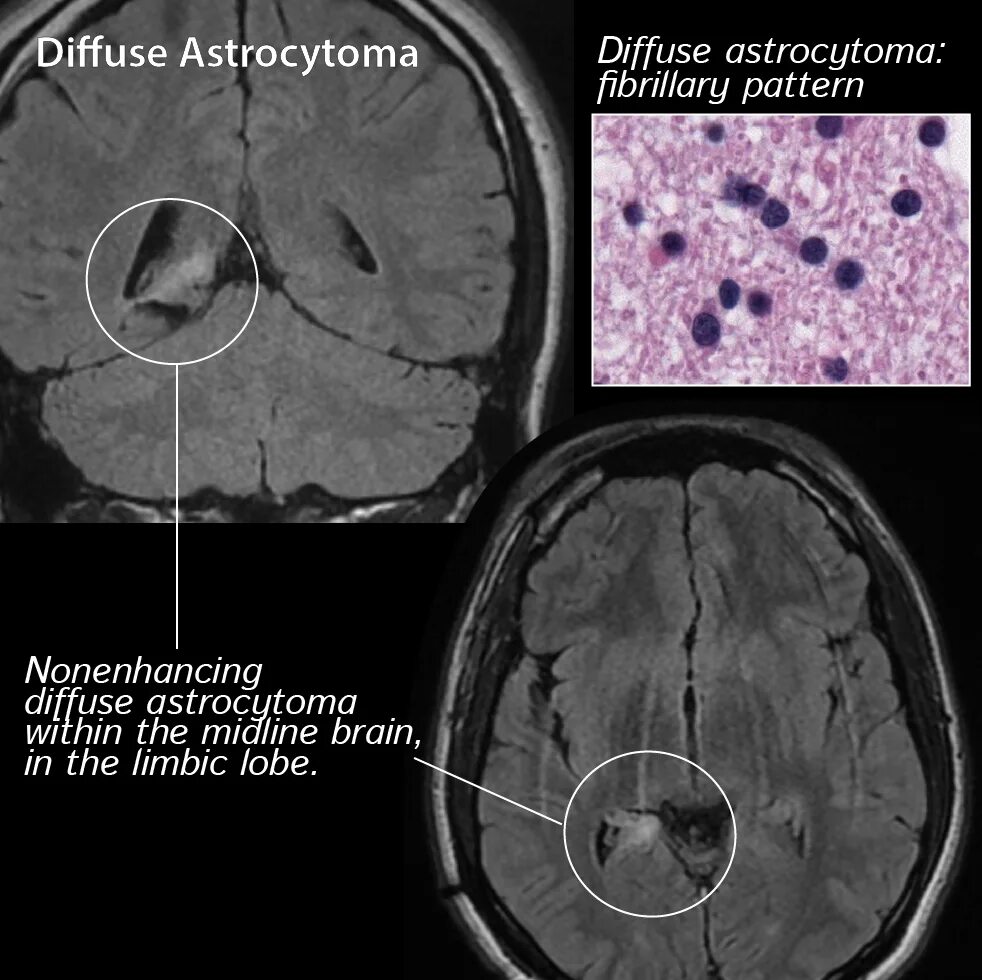 Фибриллярная астроцитома гистология. Диффузная мастоцитома. Диффузная астроцитома