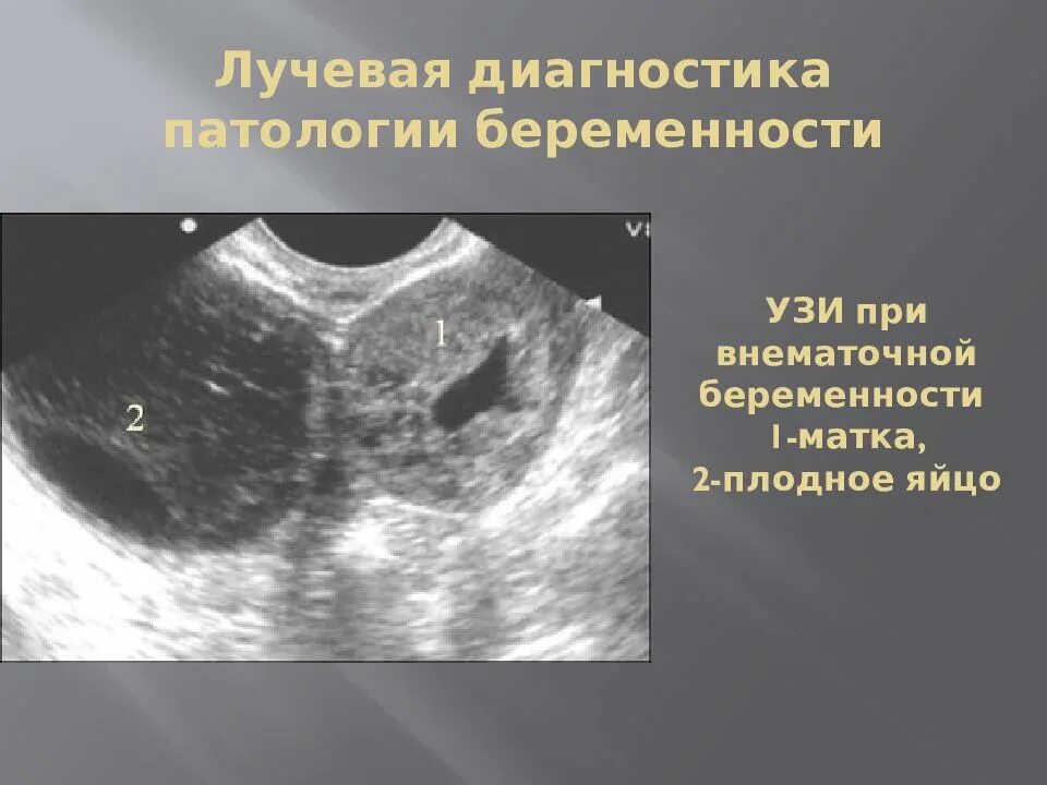 Внематочная Трубная беременность УЗИ. Внематочная беременность на УЗИ. Внематочнаябкременность УЗИ. УЗИ при внематочной беременности. На узи видна труба