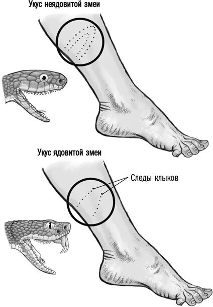 Симптомы укусов змей. Укусы ядовитых и неядовитых змей. Как выглядит укус ядовитой змеи. Как выглядит укус ядовитой и неядовитой змеи.