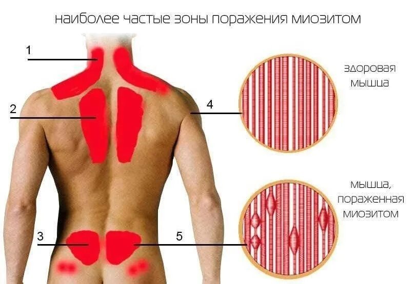 Боль в легком при пневмонии. Воспаление мышц поясницы.