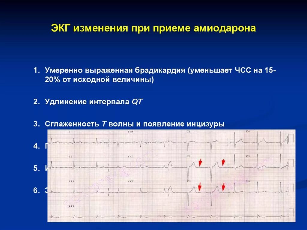 Изменения на ЭКГ. Амиодарон изменения на ЭКГ. ЭКГ при приеме амиодарона. Изменения на ЭКГ при приеме амиодарона. Удлиненный qt препараты