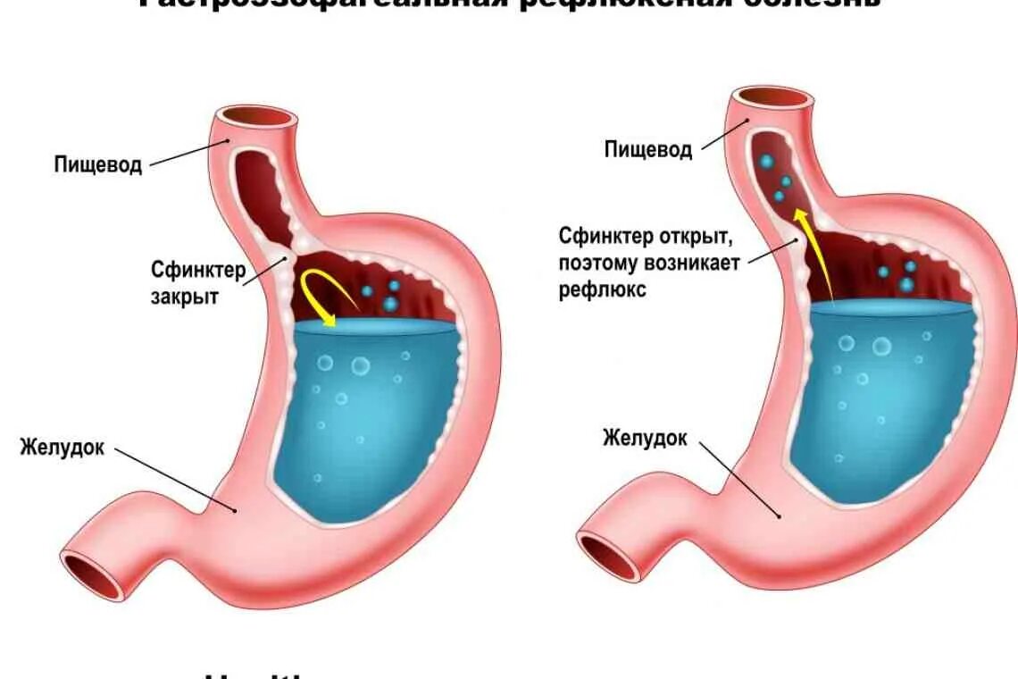 Рефлюкс сфинктера. Гастроэзофагеальный рефлюкс.