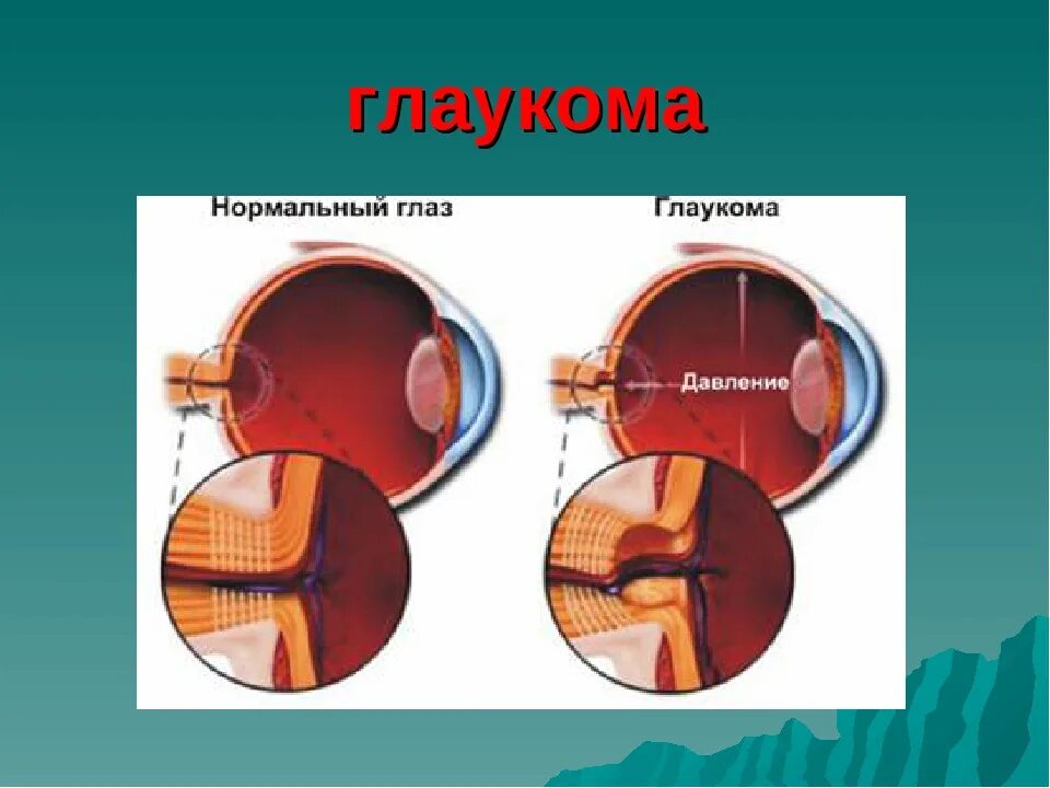 Глаукома форум. Презентация на тему глаукома. открытоугольная глаукома презентация. презентации по глаукоме офтальмология.
