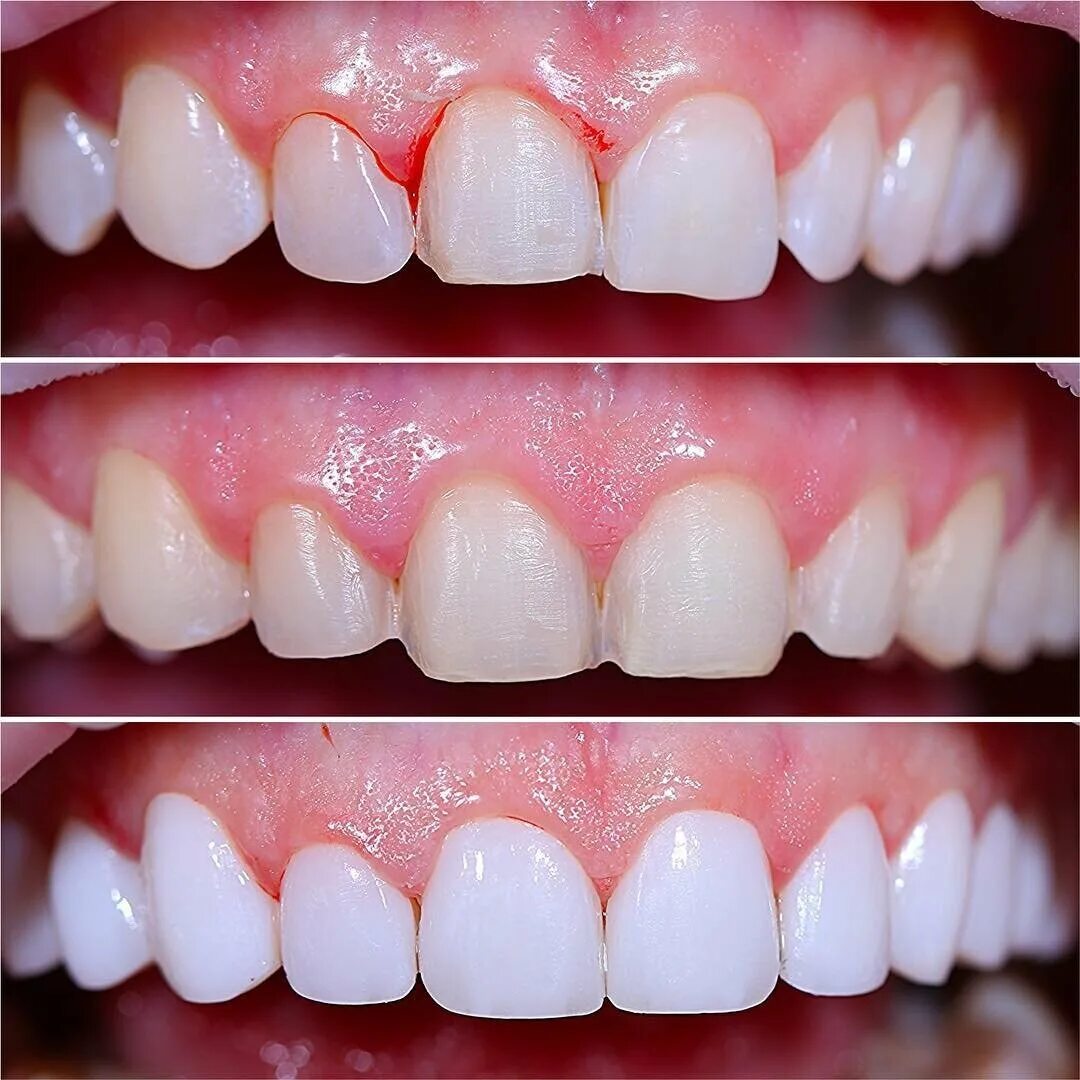 Виниры надо менять. Виниры надо менять. Юлия ахмедова виниры. Виниры надо менять. Виниры люминиры компониры.