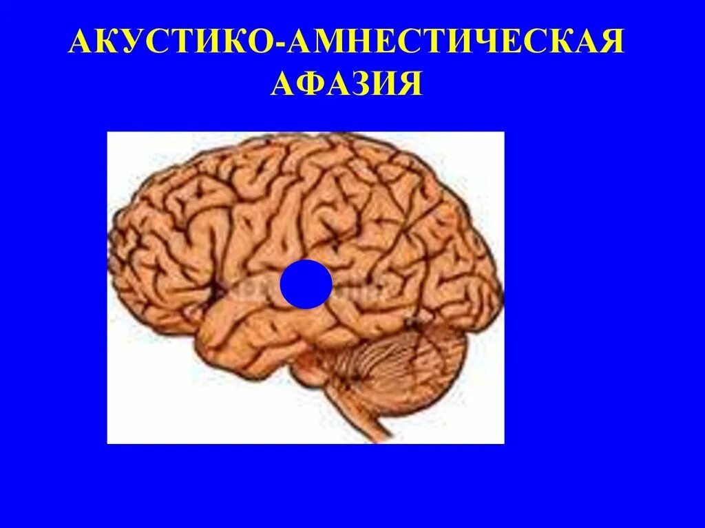 Акустико семантической афазии. Очаг поражения при амнестической афазии. акустико амнестическая афазия. сенсорная афазия зона вернике. моторная эфферентная апраксия.
