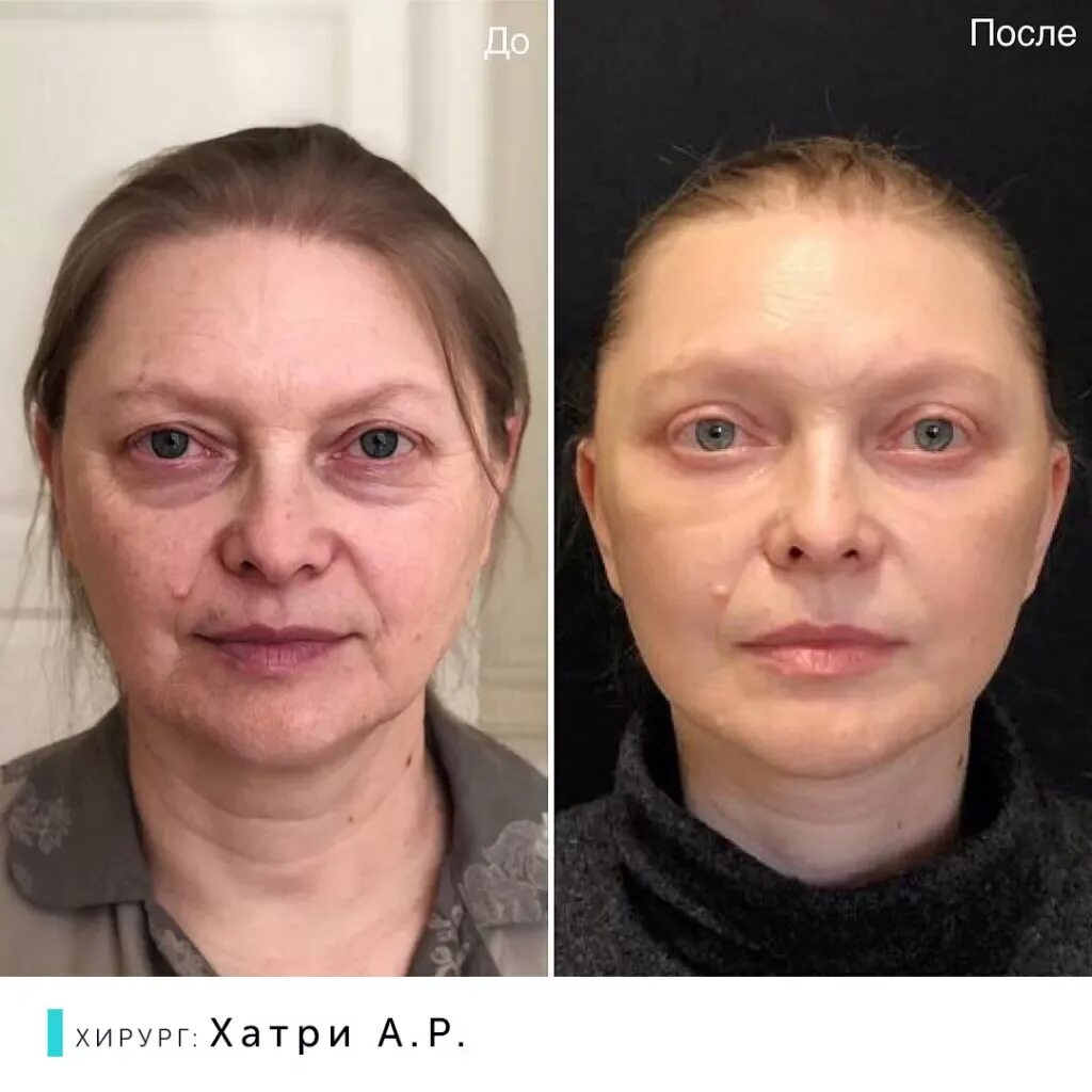 Подтянуть лицо операция. Блефаропластика и круговая подтяжки лица. чек лифтинг блефаропластика. лицо после круговой подтяжки и блефаропластики. подтянутое лицо до и после.
