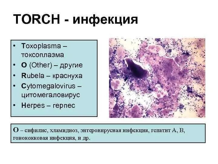 Torch инфекции что это такое. Торч инфекции. торч инфекции цитомегаловирус.