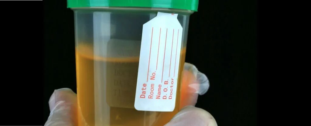Моча цвета крепкого чая. Дарк моча. why is my urine a slight green color?. джордан дарк моча коробка. golden rain pouring urine blow image.