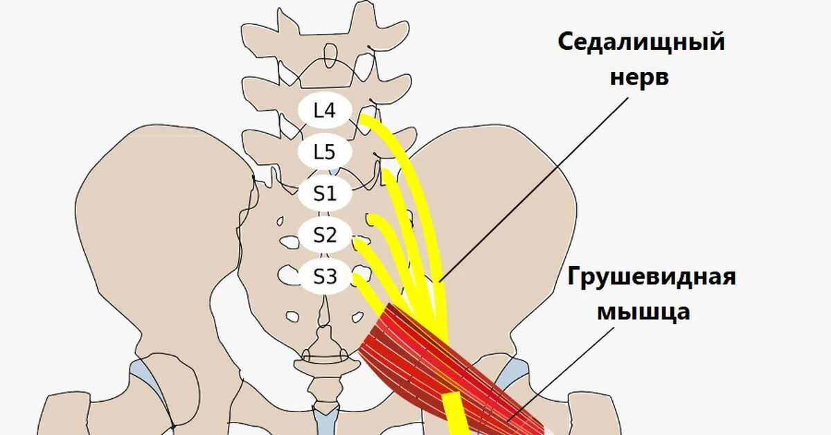 Блокада при защемлении седалищного нерва. Блокада седалищного нерва. Снять нагрузку с грушевидной мышцы. Как проходит седалищная мышца. Грушевидная мышца зажала седалищный нерв симптомы лечение.